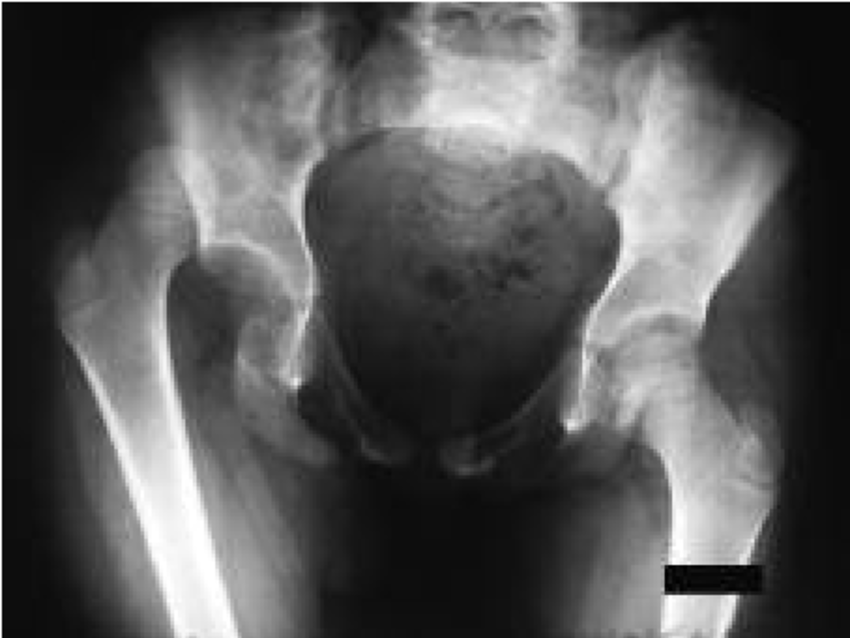 Posterior-dislocation-of-the-right-hip-without-fracture.png